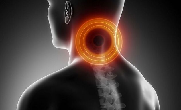 cervicalgia koos emakakaela osteokondroosiga